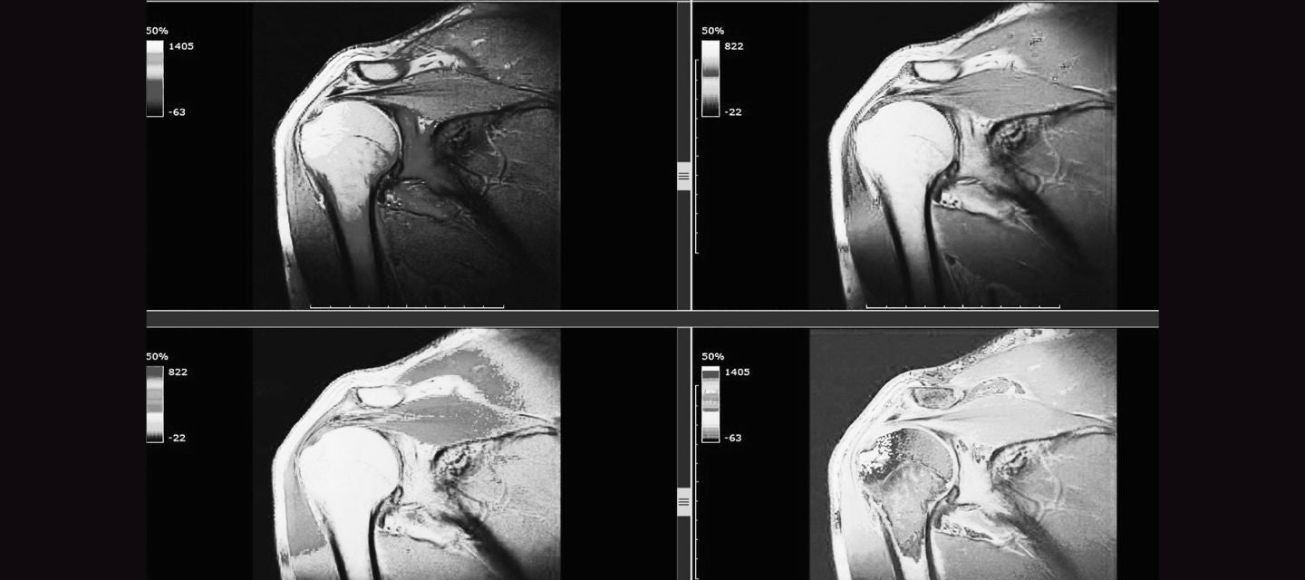 Shoulder mri i med radiology network